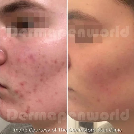 Clarion DP4 Microneedling Device