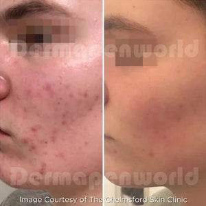 Clarion DP4 Microneedling Device