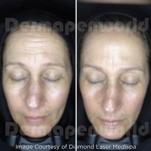 Clarion DP4 Microneedling Device