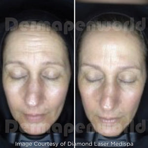 Clarion DP4 Microneedling Device