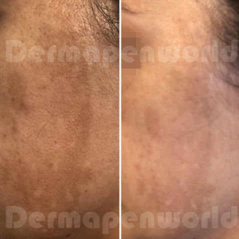 Clarion DP4 Microneedling Device