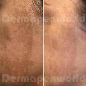 Clarion DP4 Microneedling Device