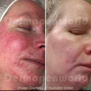 Clarion DP4 Microneedling Device