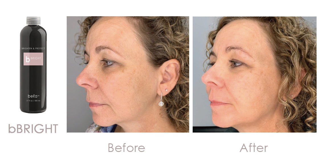 Clarion Bela MD+ Hydrodermabrasion Machine