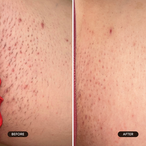 Bushbalm Berry Crush Ingrown Hair Oil (30 ml) *Limited Edition*