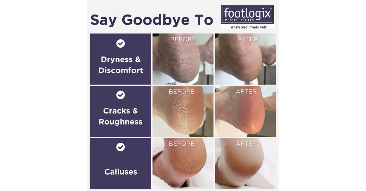 Footlogix Bye Bye Callus Kit
