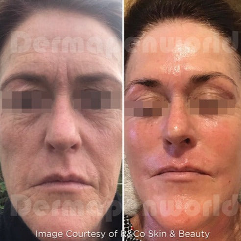 Clarion DP4 Microneedling Device