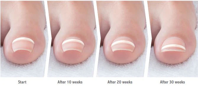 Onyfix Nail Correction System Starter Kit - PRO CERTIFICATION REQUIRED