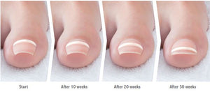 Onyfix Nail Correction System Starter Kit - PRO CERTIFICATION REQUIRED