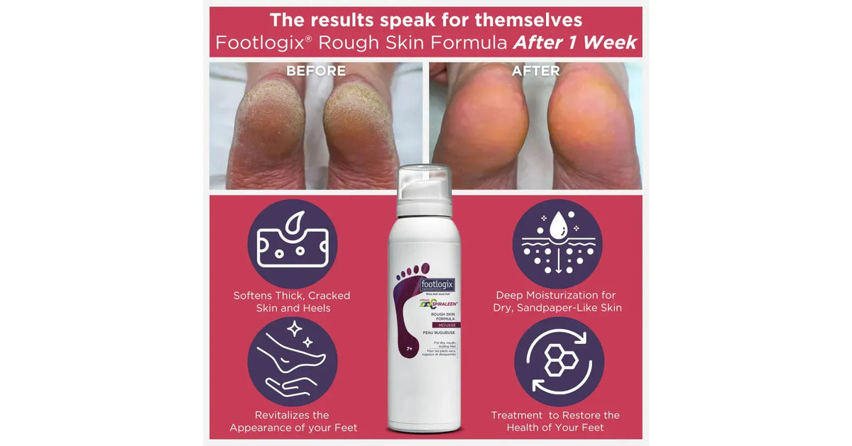 Footlogix Bye Bye Callus Kit
