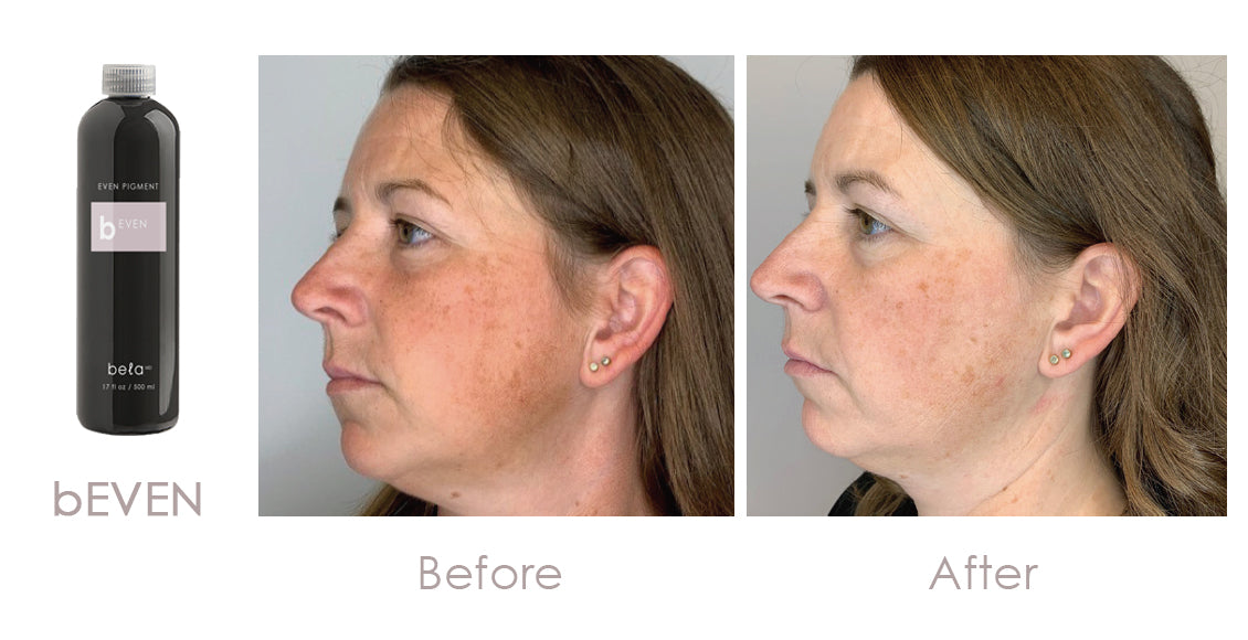 Clarion Bela MD+ Hydrodermabrasion Machine